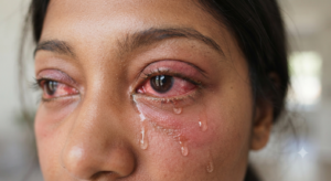 Common symptoms and signs of viral conjunctivitis